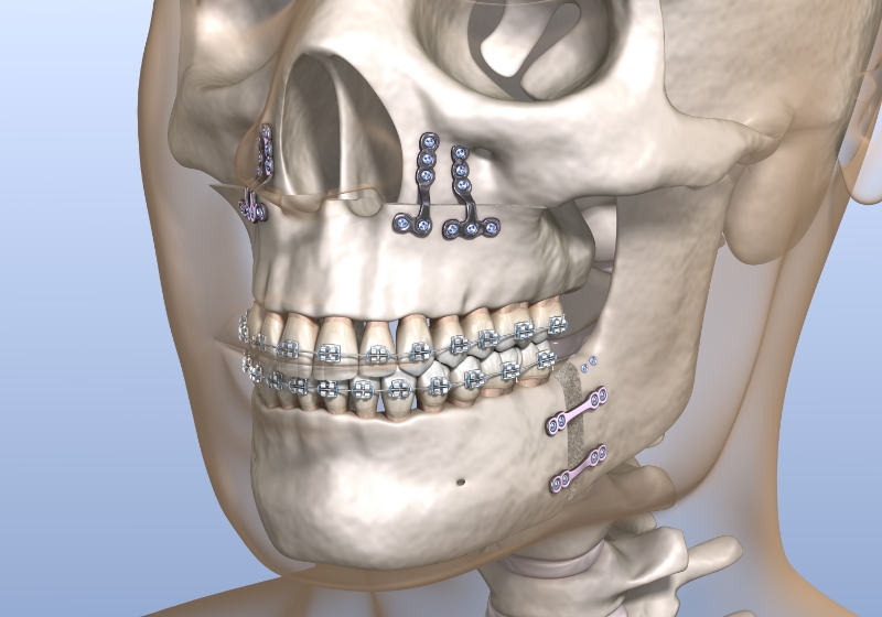 Tratamentul combinat ortodontic-chirurgical